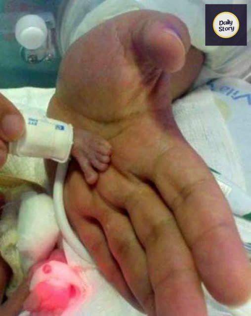 One of the smallest babies in the world was born..!