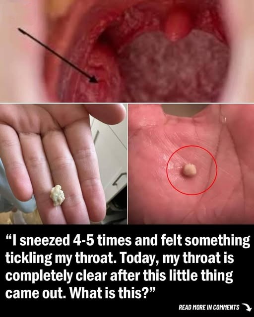 Here is what you need to know about tonsil stones, the weird pimple like growths in your throat